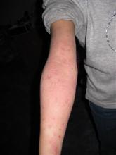 eczema arms after